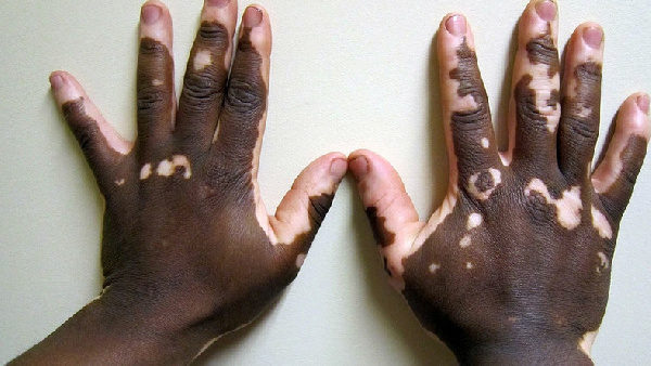 World Vitiligo day: Know the causes, symptoms and treatment for Vitiligo 5