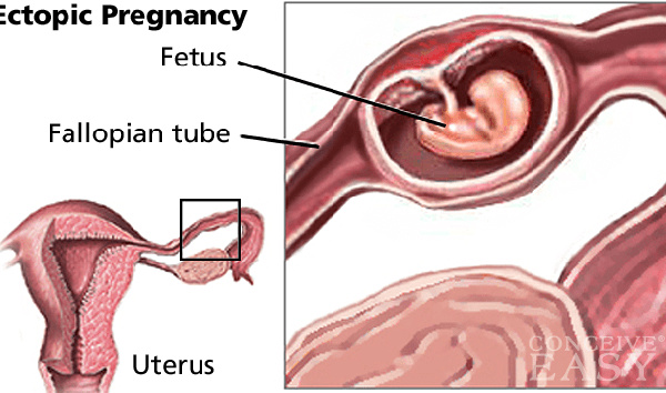 Multiple abortions leading cause of ectopic pregnancy – Expert 29